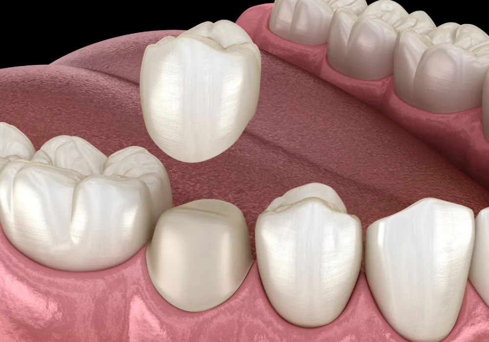 3D illustration of a dental crown being placed over a prepared tooth
