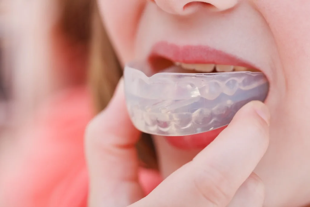 Close-up of patient inserting a custom mouthguard over teeth