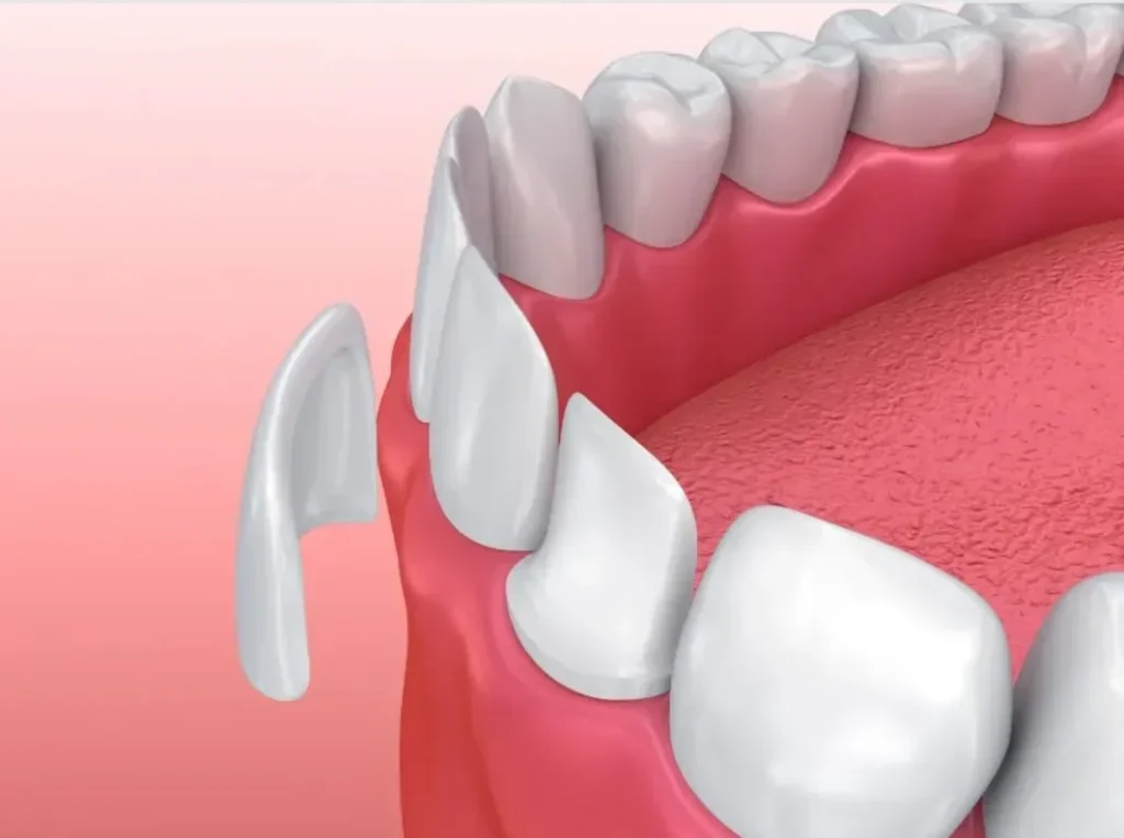 3D illustration of porcelain veneer being placed on a front tooth