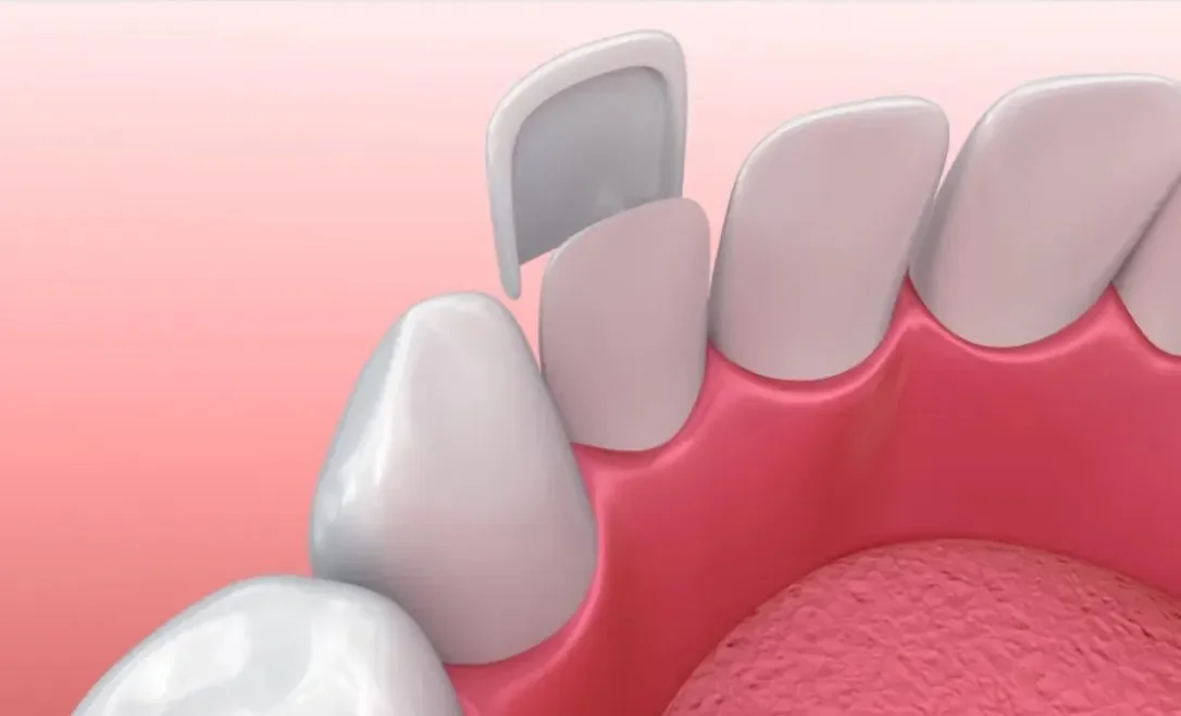 Graphic showing thin porcelain veneer bonding to the tooth surface