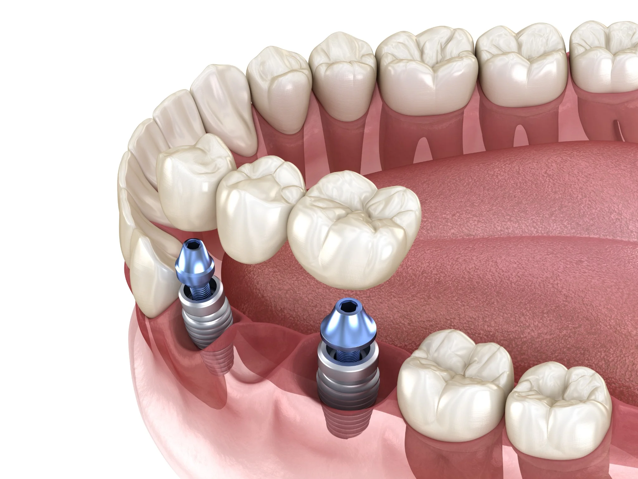 dental-bridge-supported-by-implants