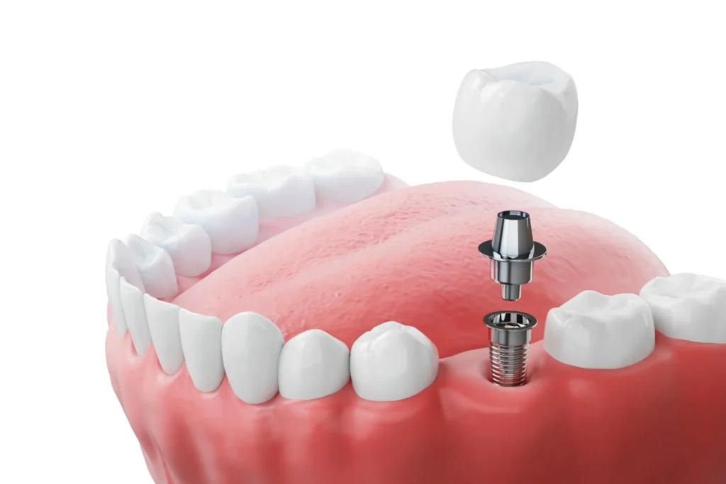 single-dental-implant