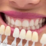 dental veneers fresno ca — smile transformation consultation at One Dental Place