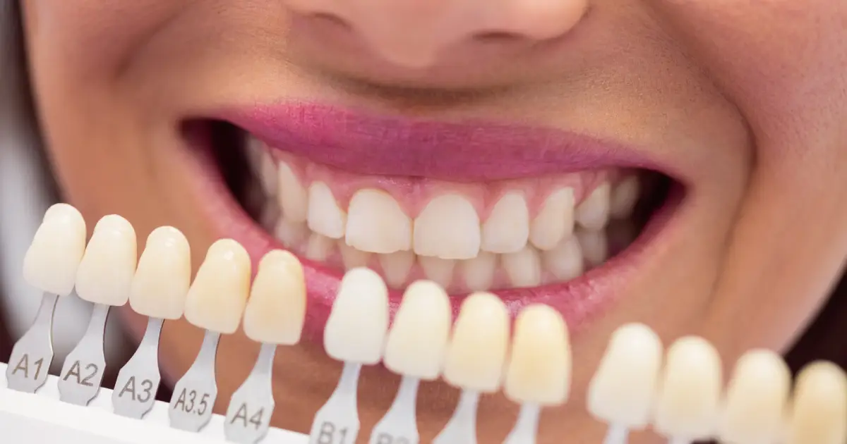 Dental Veneers Fresno CA 93720 — Honest Costs and What to Expect